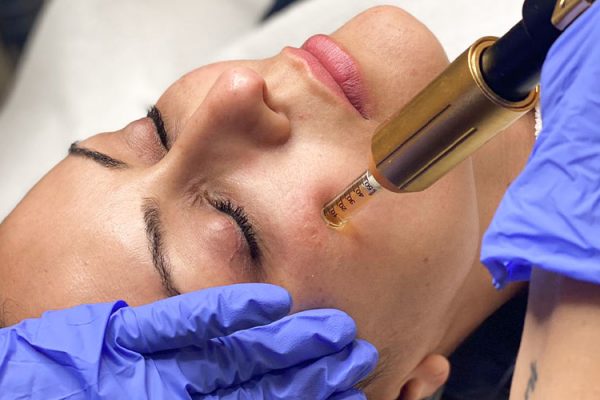 Procedimento Charmed Pen Tonya Beauty Medical Spa